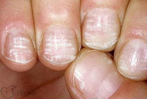 Борозды на ногтях: причины возникновения и способы устранения.