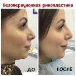 Безоперационная ринопластика носа – коррекция без операции (2021)