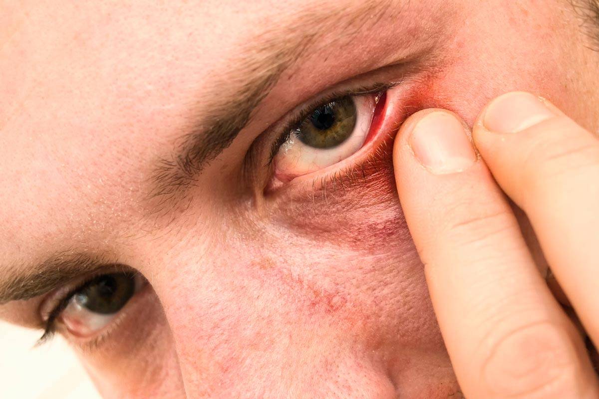 Фурункул на глазу как лечить – лечение артроза и артрита, лечение подагры