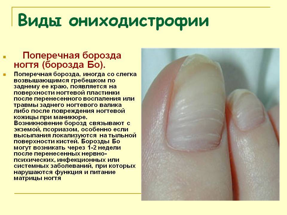 Почему ногти на руках становятся волнистыми и как лечить дефект?