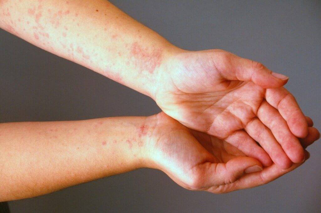 Холодовый дерматит: лечение на руках, лице