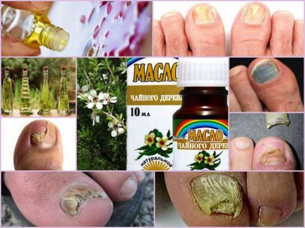 Свойства и рекомендации по применению масла чайного дерева от грибка ногтей