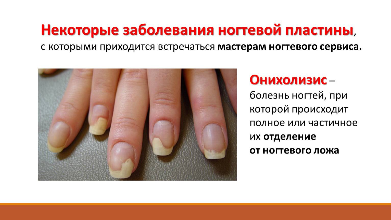 Диагноз по ногтям: на пальцах рук ставят при первых симптомах болезней
