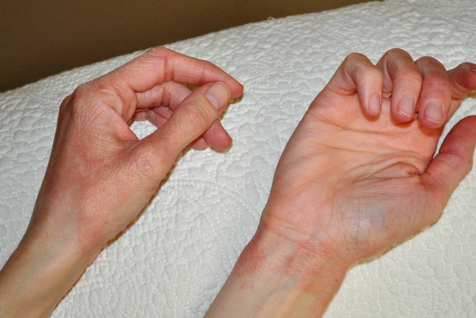 Крапивница на руках: фото, симптомы, причины и лечение