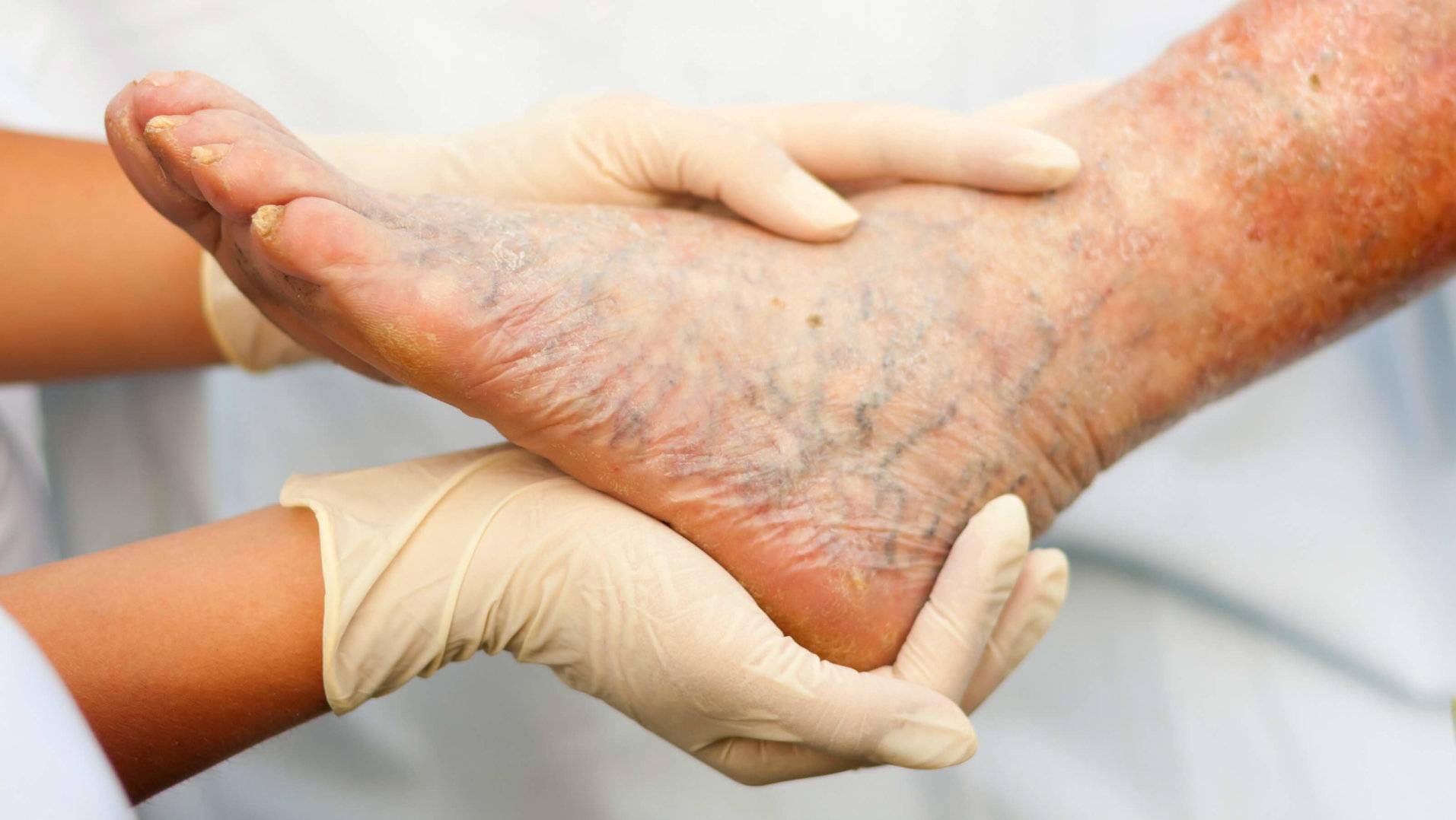 Экзема: причины и лечение на руках, ногах, пальцах и теле