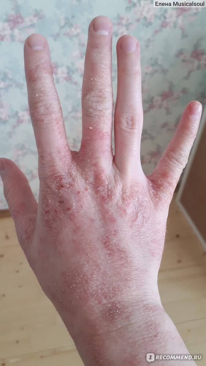 Заболевания кожи рук