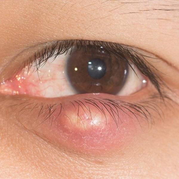 Причины, фото и лечение фурункула на глазу у взрослых и детей