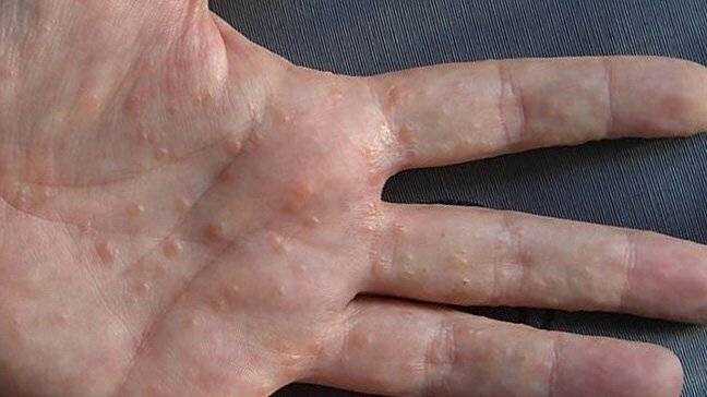 Как отличить экзему на руках от грибка - лечим кожу