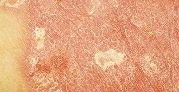 Генерализованный пустулезный псориаз цумбуша: причины, симптомы, лечение