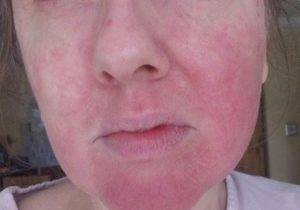 Крапивница на лице — это острая аллергическая реакция! причины возникновения, методы лечения и профилактика возникновения сыпи
