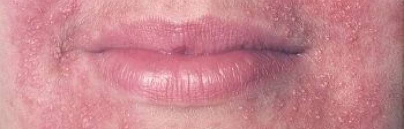 Периоральный дерматит — воспаление эпидермиса вокруг рта