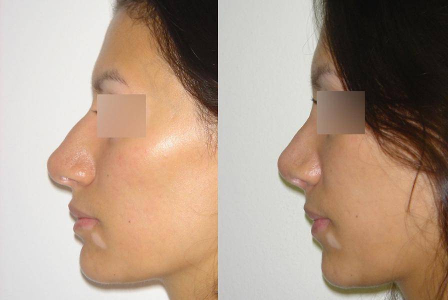 Горбинка без операции. Ринопластика горбинки носа. Ринопластика носа с горбинкой до и после.