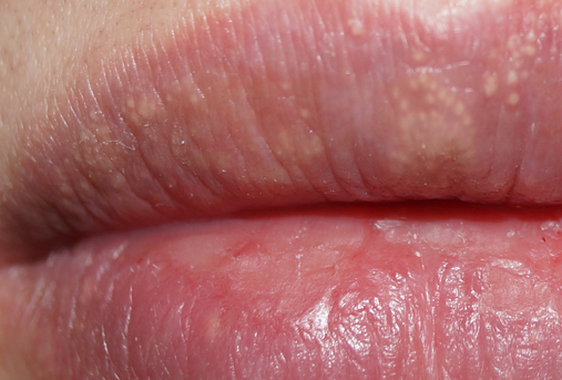 Папилломы на половых губах у женщин: причины, симптомы, опасность, лечение, профилактика и диета