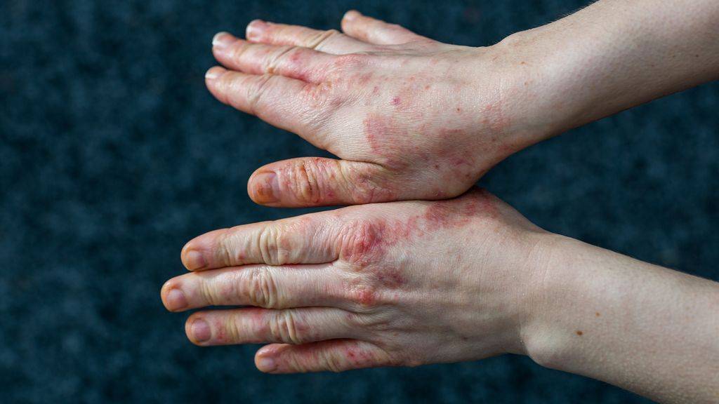 Холодовой дерматит на руках и экзема на лице: лечение и профилактика в холода | moninomama.ru