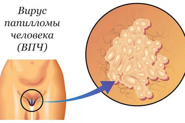 Вирус папилломы человека: симптомы у женщин и мужчин, диагностика и лечение