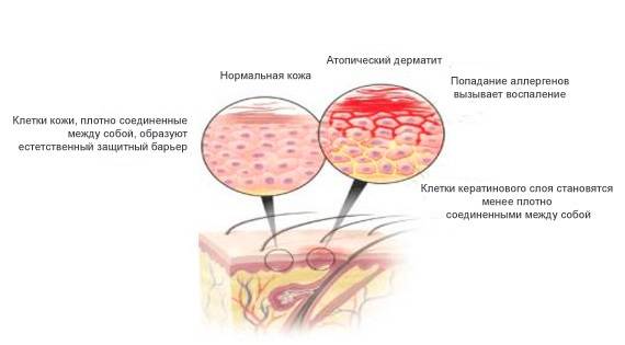 Причины и лечение инфекционного дерматита