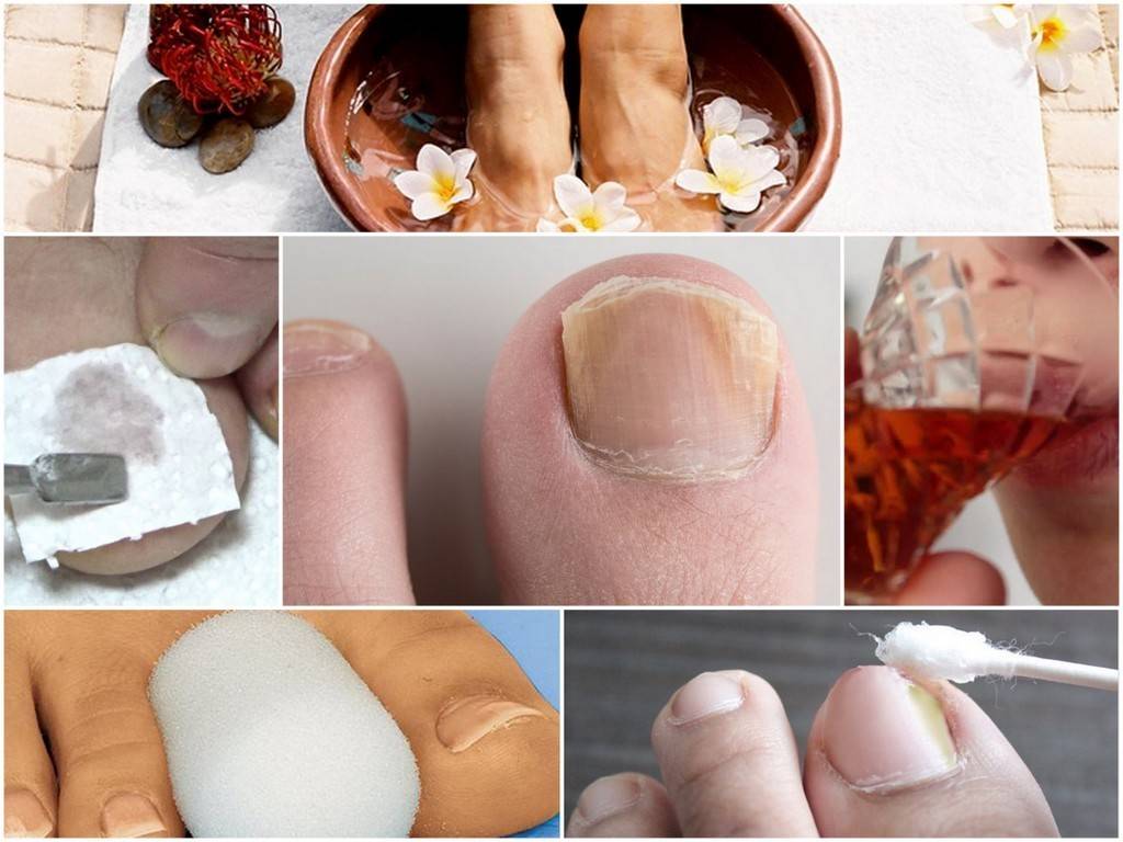 Лечение грибка на ногах народными средствами - эффективные рецепты домашних ванночек и препаратов
