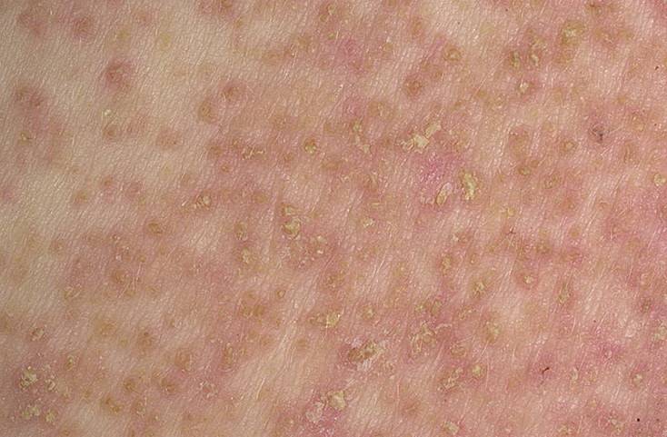 Пузырчатый дерматит: причины, симптомы и его лечение